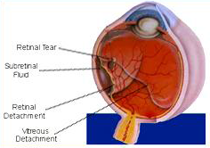 retina detachment surgery success rate